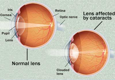 Cataract Exam Flushing