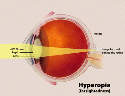 Farsightedness Flushing