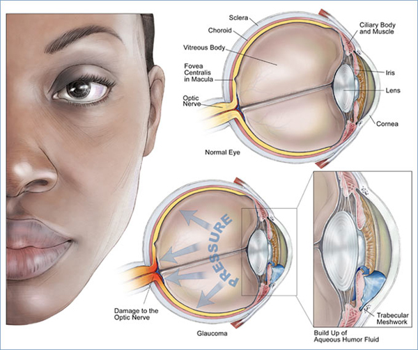 Glaucoma Testing Flushing