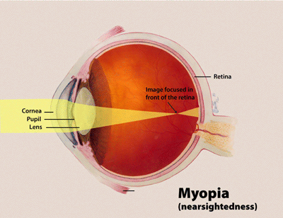 Flushing Nearsightedness